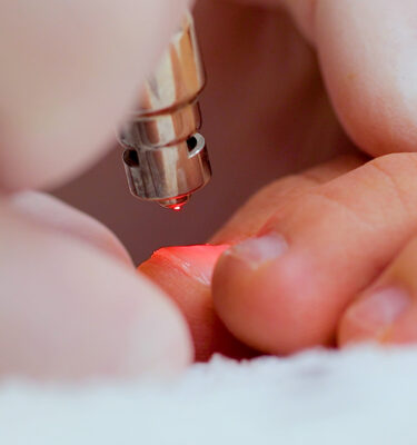 Light Touch Laser Spa NYC Fungus laser removal for feet Manhattan laser hair removal spa buy online