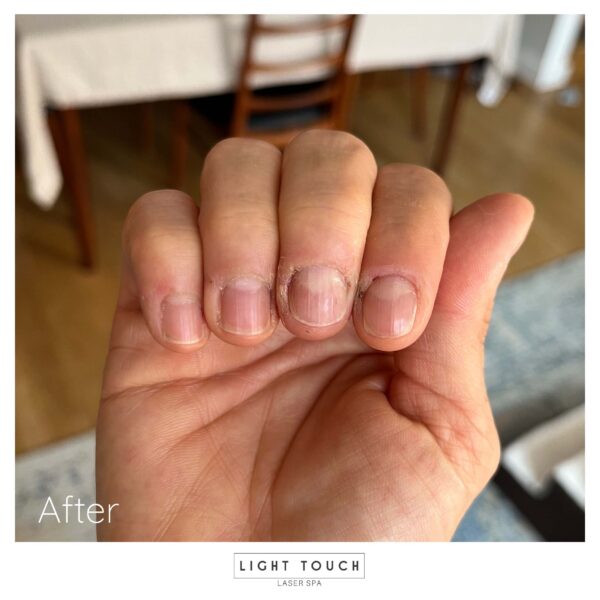 Light Touch Laser Spa NYC Laser Nail Therapy fingernails after treatment results advanced laser treatments