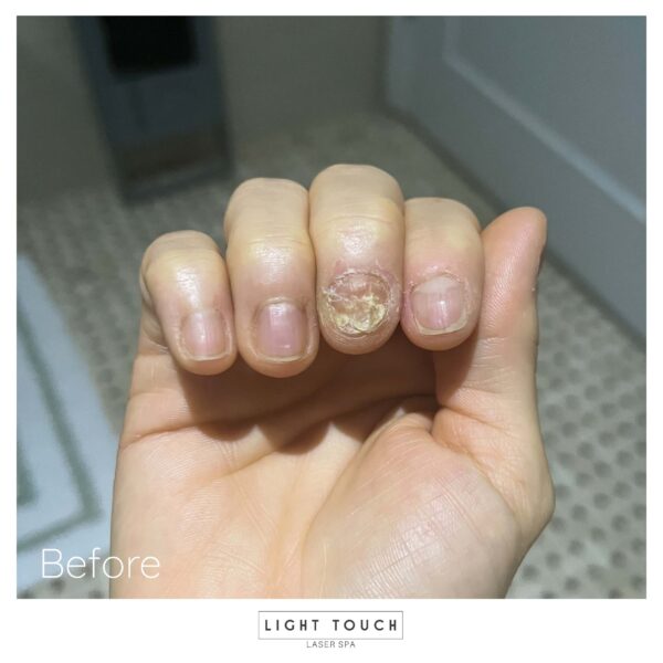 Light Touch Laser Spa NYC Laser Nail Therapy fingernails before treatment advanced laser treatments