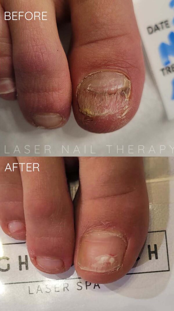 Light Touch Laser Spa NYC NYC's best laser spa laser nail therapy story results