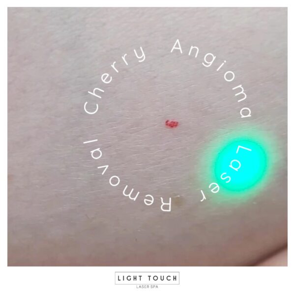 Laser Touch laser spa NYC red bumps on the skin post 1 Cherry Angioma advanced treatment for you and you body