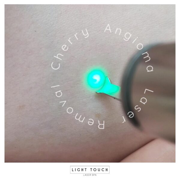 Laser Touch laser spa NYC red bumps on the skin post 2 Cherry Angioma advanced treatment for you and you body