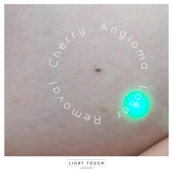 Laser Touch laser spa NYC red bumps on the skin post 3 Cherry Angioma advanced treatment for you and you body